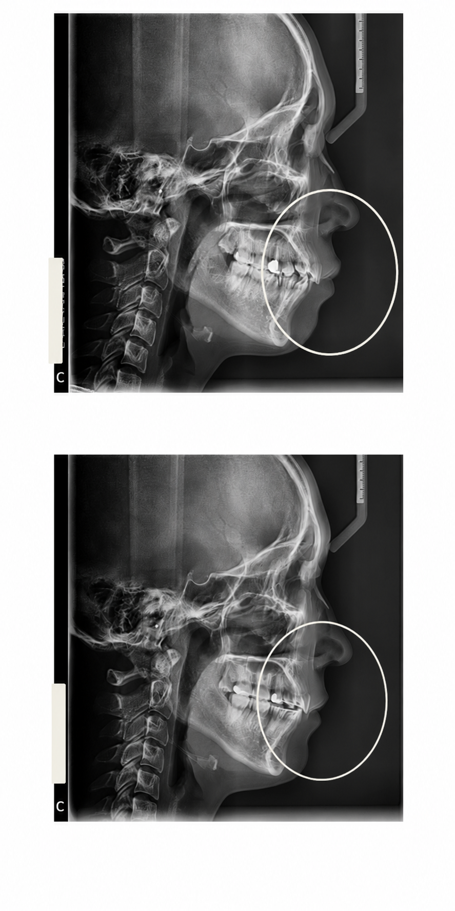 Protruding teeth before and after at Baro Dental Clinic Busan — orthodontic case 12