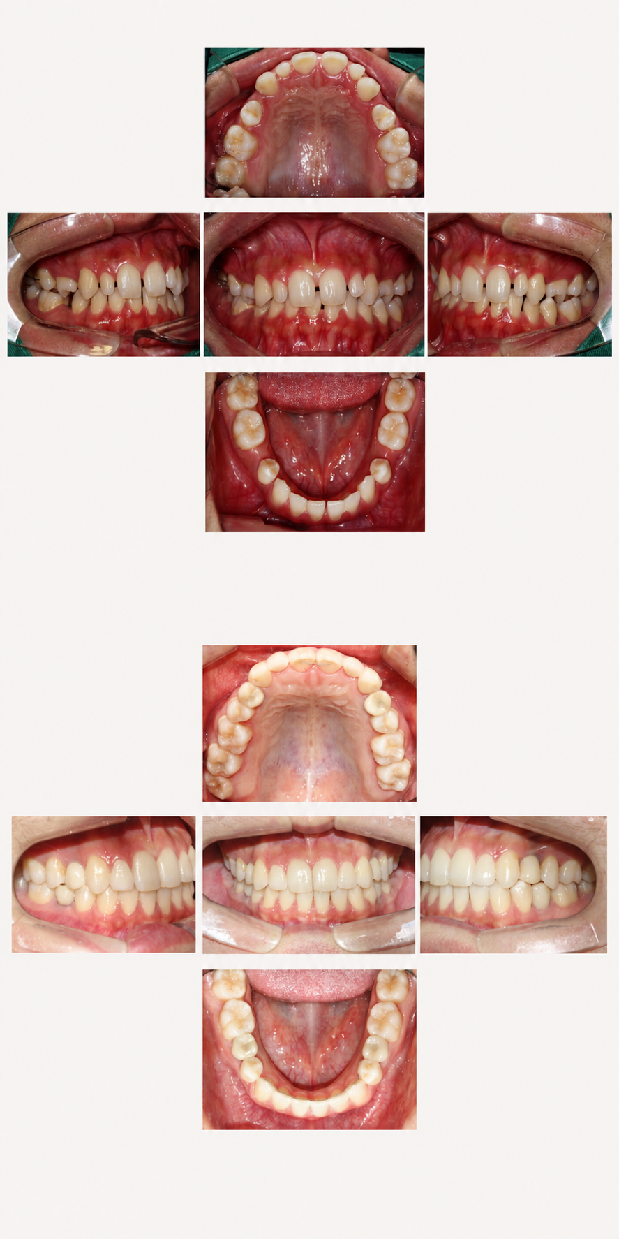 Spacing and gaps before and after at Baro Dental Clinic Busan — orthodontic case 21