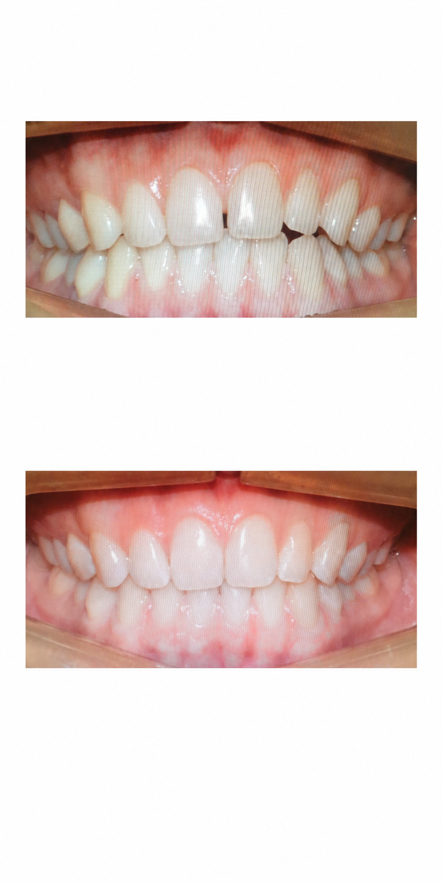 Spacing and gaps before and after at Baro Dental Clinic Busan — orthodontic case 22