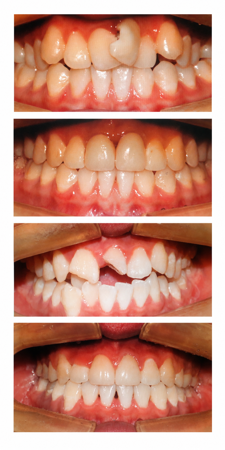Orthodontics + prosthetics before and after at Baro Dental Clinic Busan — orthodontic case 35