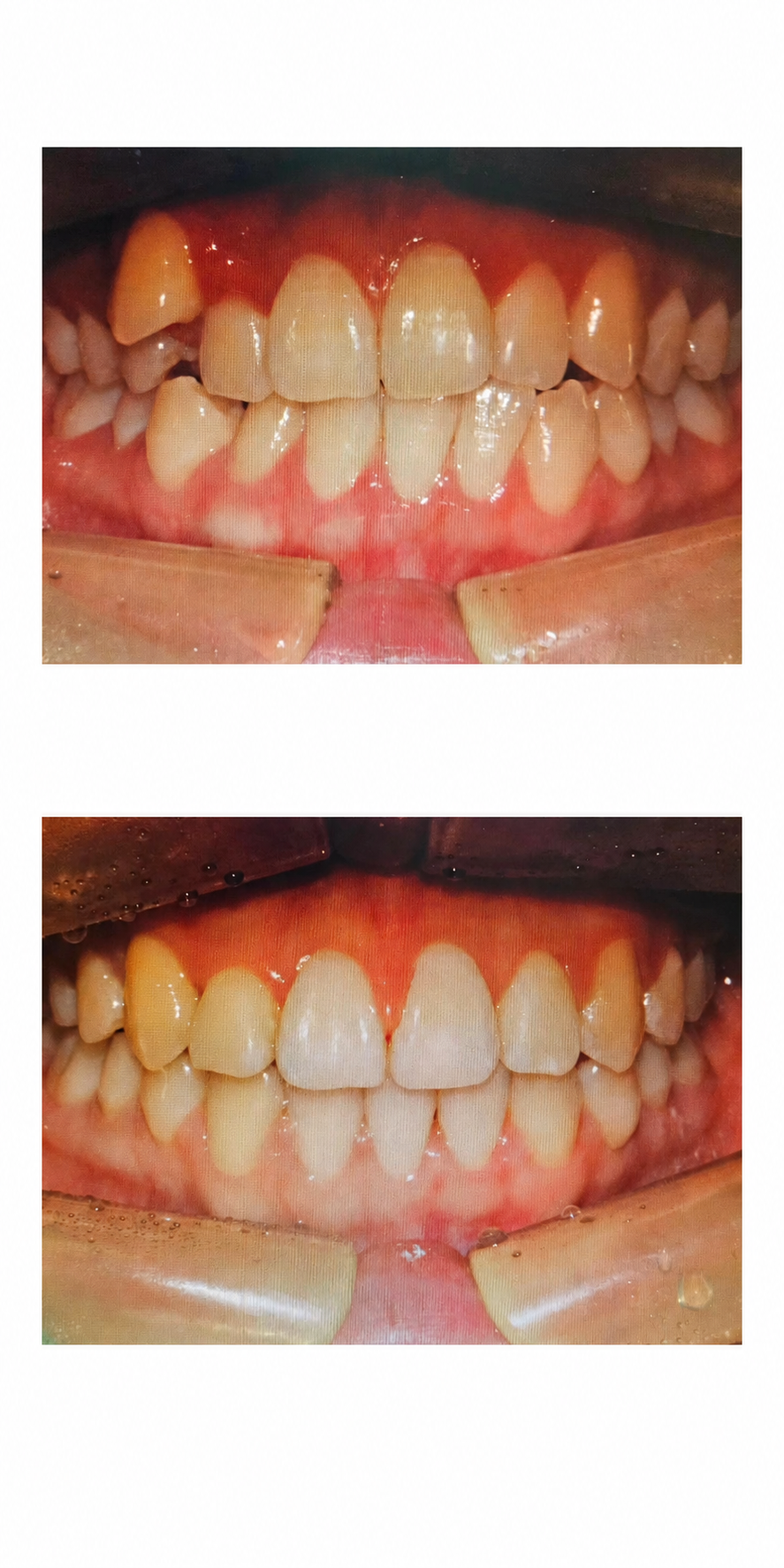 Complex case before and after at Baro Dental Clinic Busan — orthodontic case 30