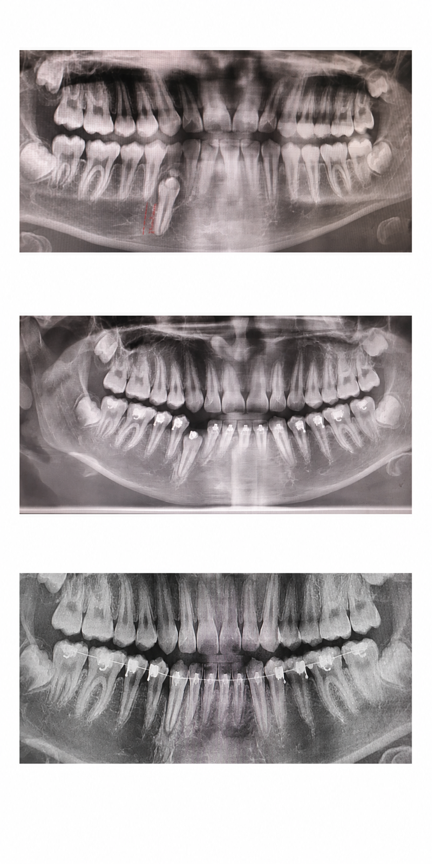 Complex case before and after at Baro Dental Clinic Busan — orthodontic case 32