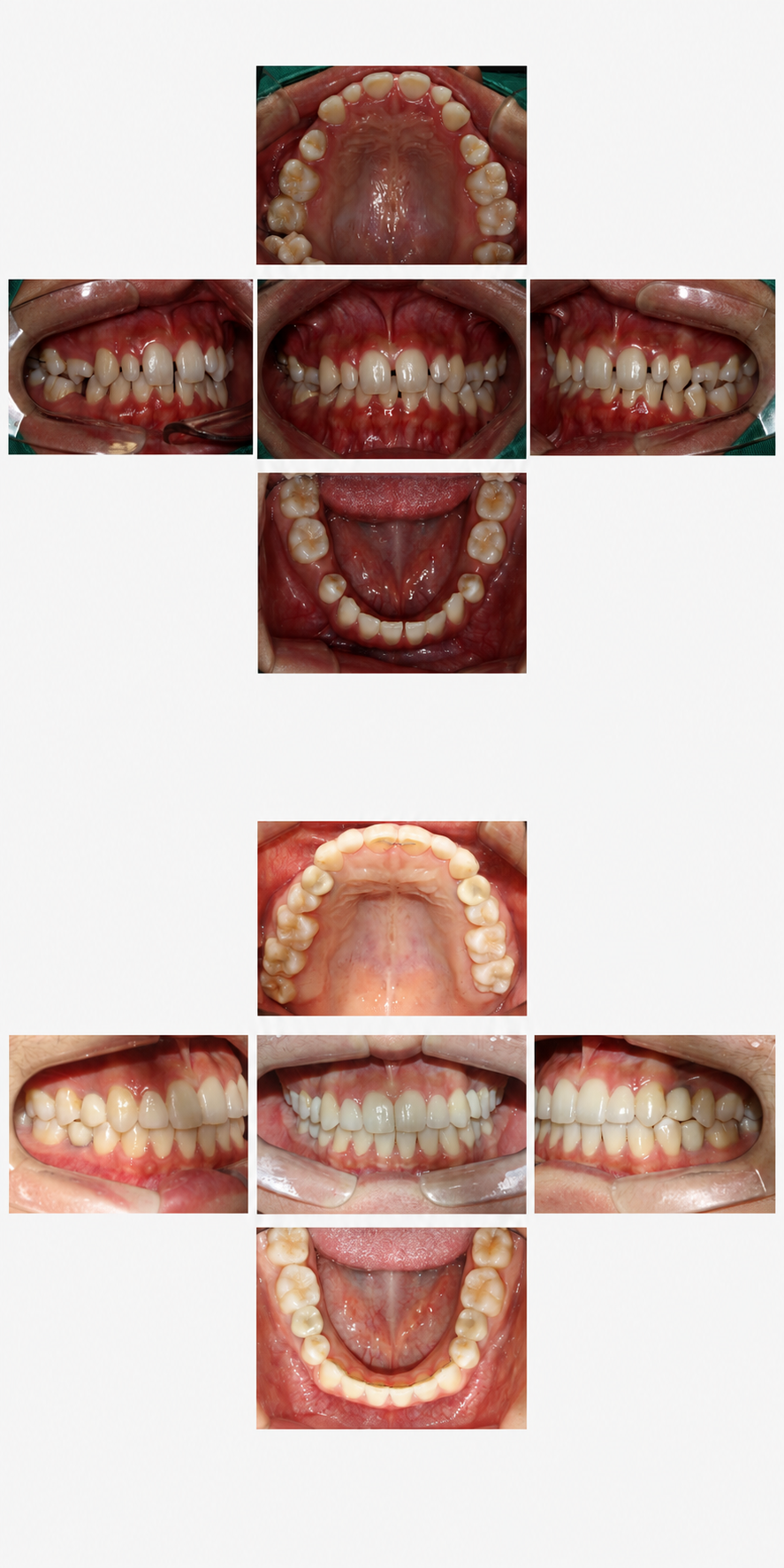 Severe rotation before and after at Baro Dental Clinic Busan — orthodontic case 33