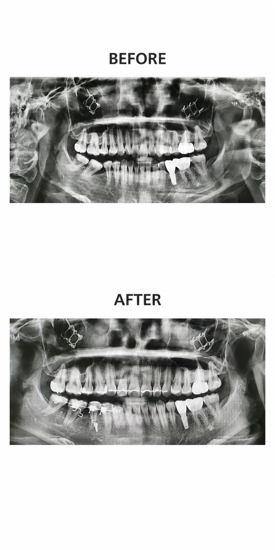 Molar up-righting before and after at Baro Dental Clinic Busan — orthodontic case 34