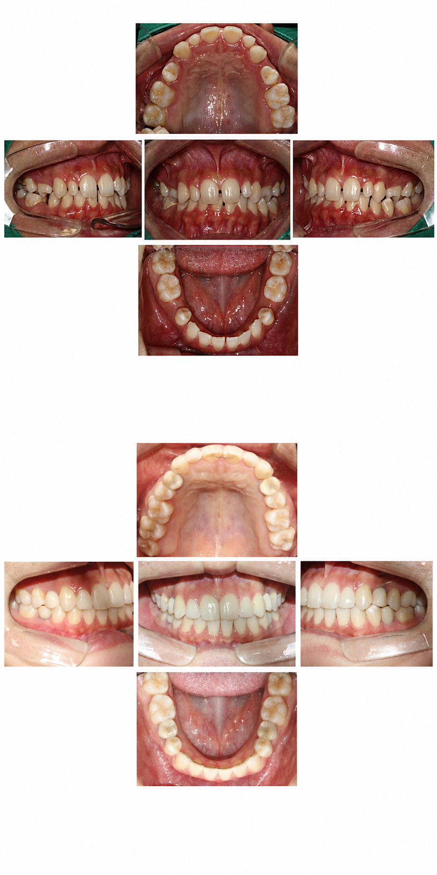 Orthodontics + prosthetics before and after at Baro Dental Clinic Busan — orthodontic case 36