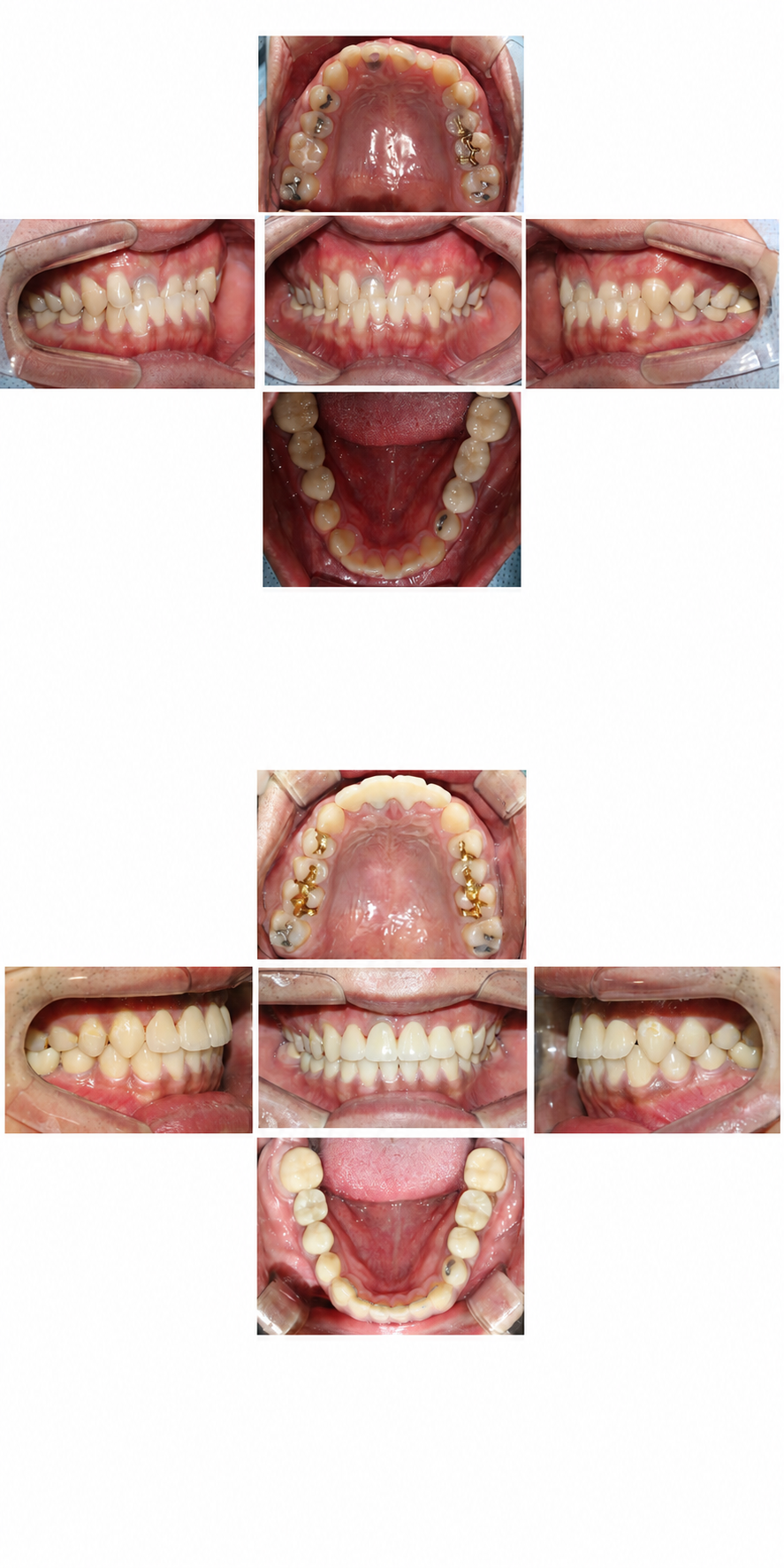 Orthodontics + implant before and after at Baro Dental Clinic Busan — orthodontic case 37
