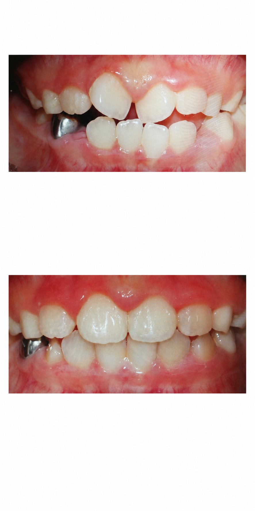 Growth-stage treatment before and after at Baro Dental Clinic Busan — orthodontic case 26