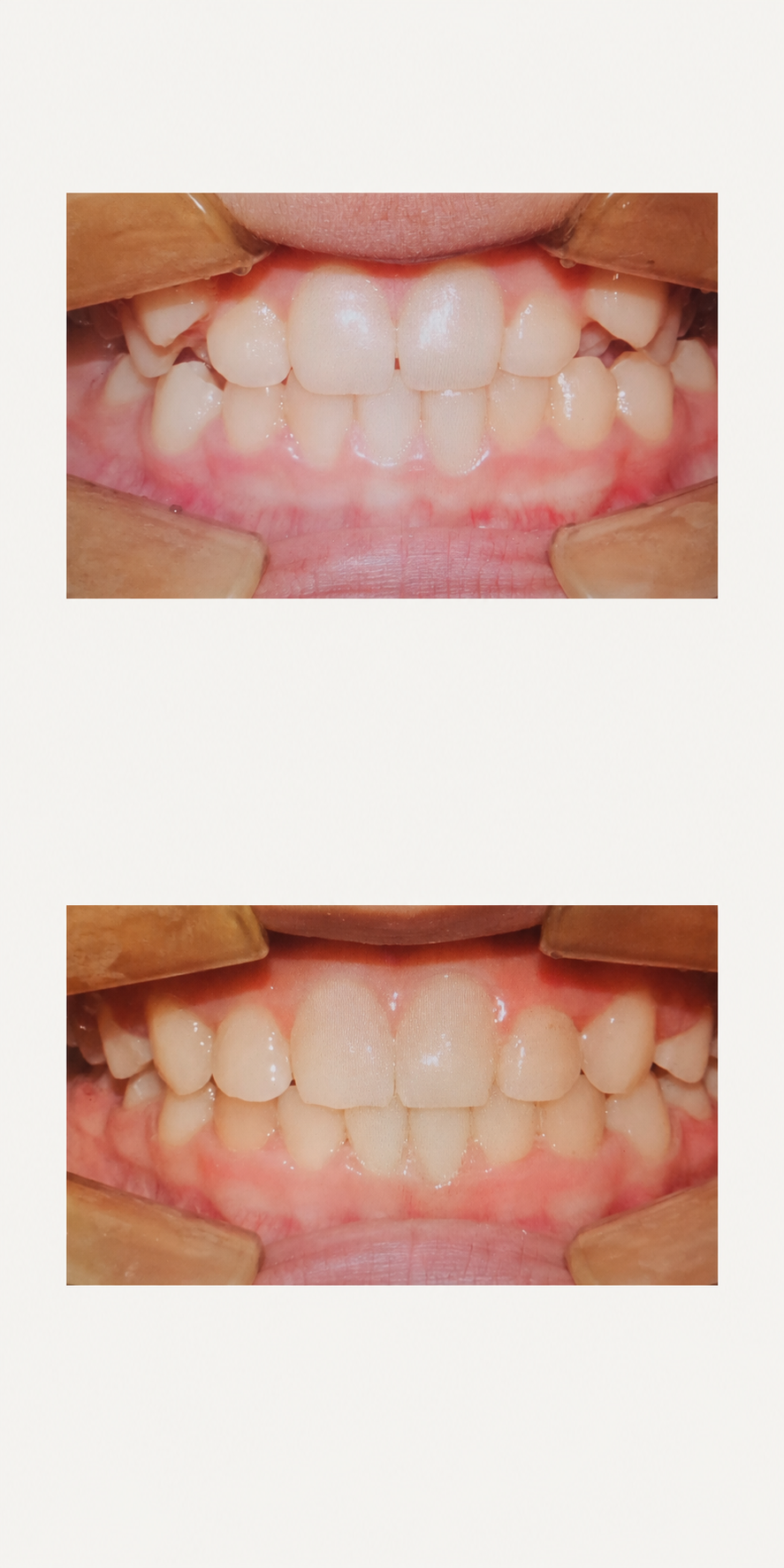 RPE palatal expansion before and after at Baro Dental Clinic Busan — orthodontic case 27