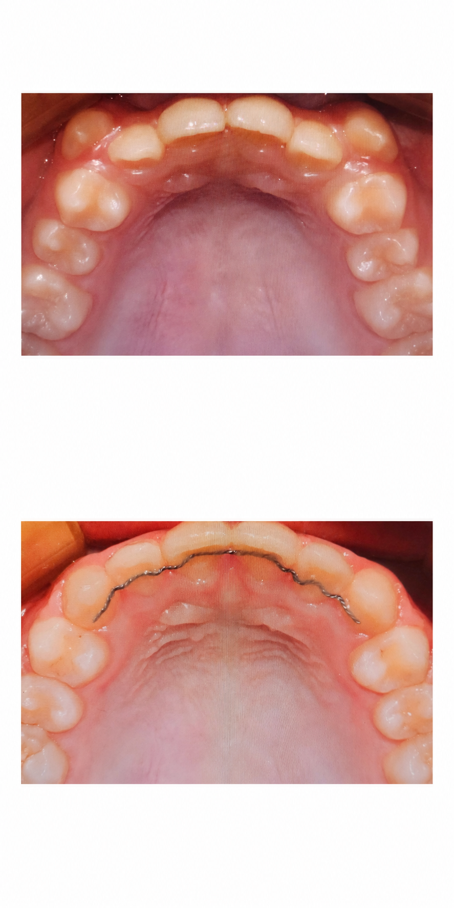 RPE palatal expansion before and after at Baro Dental Clinic Busan — orthodontic case 28