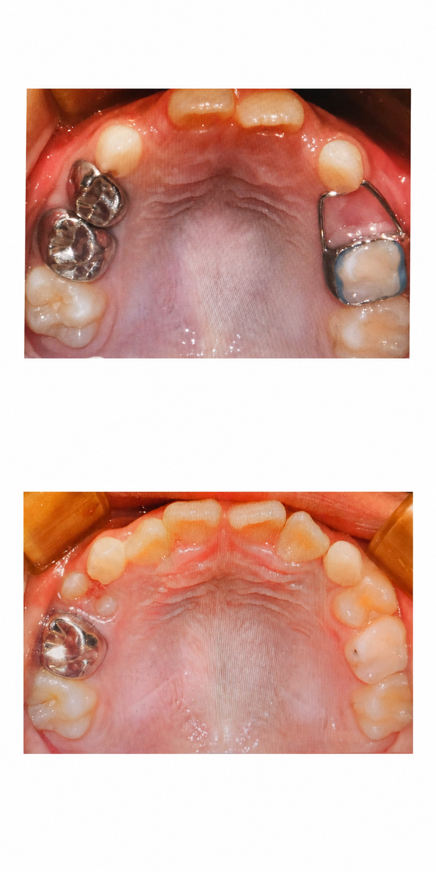 RPE palatal expansion before and after at Baro Dental Clinic Busan — orthodontic case 29