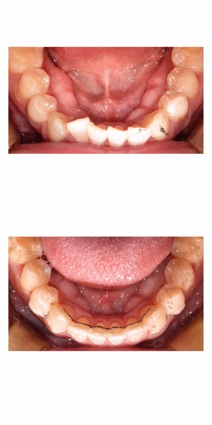 Partial braces before and after at Baro Dental Clinic Busan — orthodontic case 23