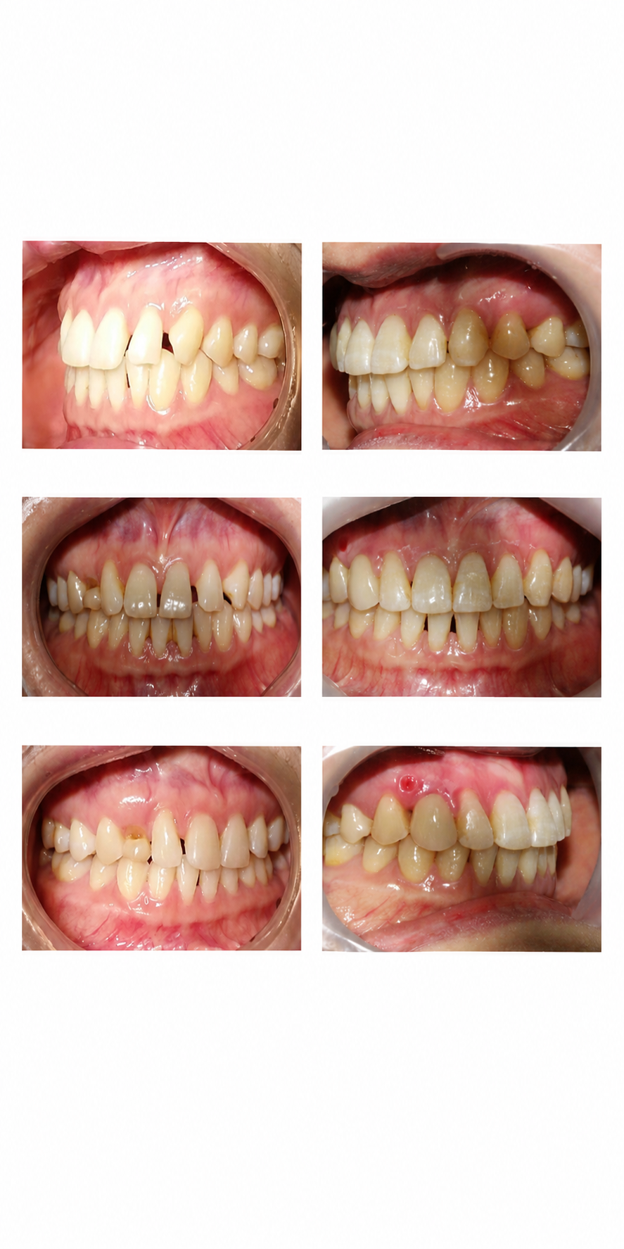 Partial braces before and after at Baro Dental Clinic Busan — orthodontic case 24