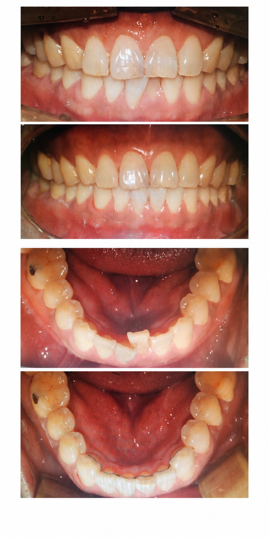 Partial braces before and after at Baro Dental Clinic Busan — orthodontic case 25