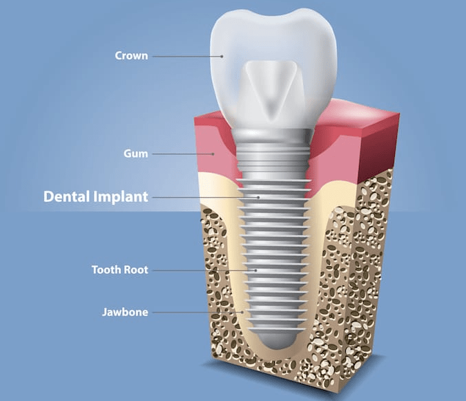 How bone grafting rebuilds the ridge for implants — scaffold principle explained, Baro Dental Busan