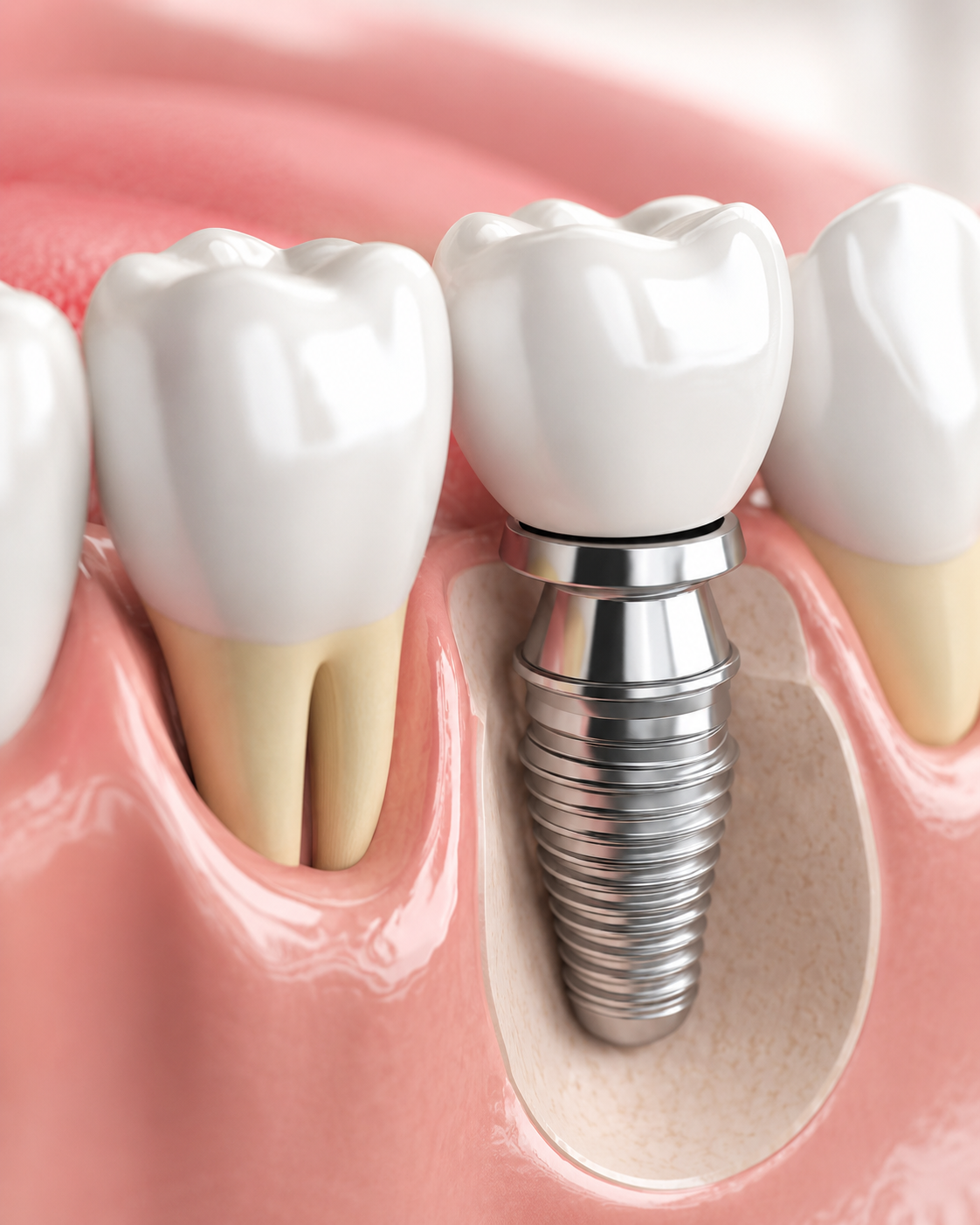 Clear aligner versus braces pricing at a Busan orthodontic clinic