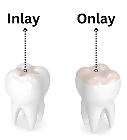 Inlay vs onlay explained — E-max ceramic fit and coverage, Baro Dental Busan