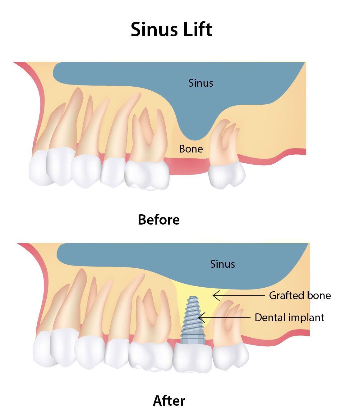 Maxillary sinus anatomy and sinus lift explained — membrane and bone height, Baro Dental Busan