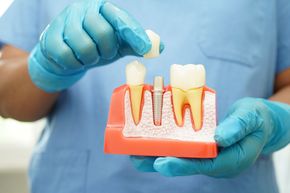 A dentist is holding a model of a dental implant in his hands.