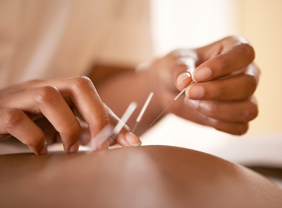 A person is getting acupuncture on their knee.