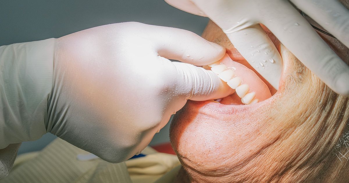dental implants vs bridges