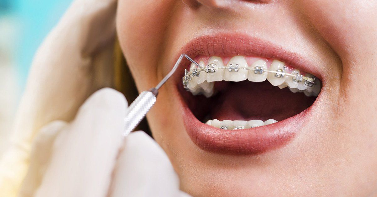 braces
