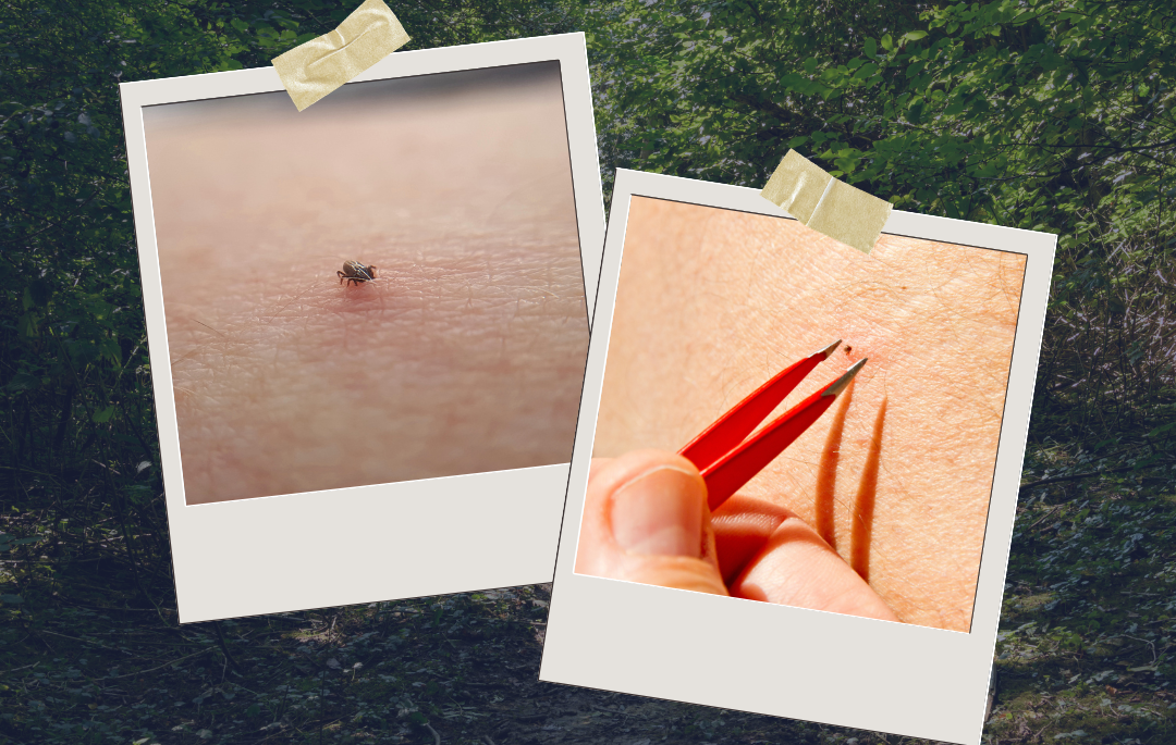 close-up skin tick and tweezers to remove a small tick.
