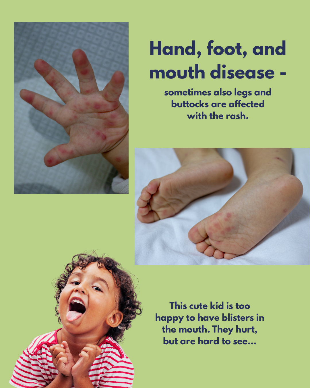 Pictures of a hand and feet with blisters and a child showing their tongue. Title reads hand, foot, and mouth disease - sometimes also legs and buttocks are affected with the rash. Next to the child it reads this cut kids is too happy to have blisters in the mouth. They hurt but are hard to see. 