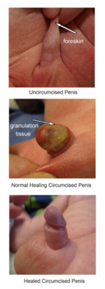 Three panels showing an uncircumcised penis, a healing circumcised penis with granulation tissue, and a healed penis.