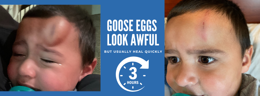 Toddler with huge bump beside text “Goose Eggs Look Awful” on a blue background, with a comparison photo on the right showing only a small scrape and early bruise.