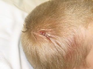 A close-up of a small, red, linear lesion on a scalp with light hair.
