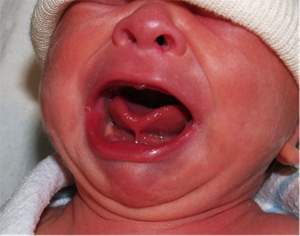 A newborn with a noticeable tongue-tie, characterized by a short, tight lingual frenulum restricting tongue movement.