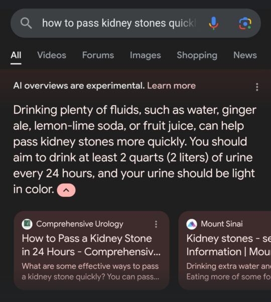 Google search results on passing kidney stones quickly: text suggesting drinking fluids, including 2 liters of urine daily.