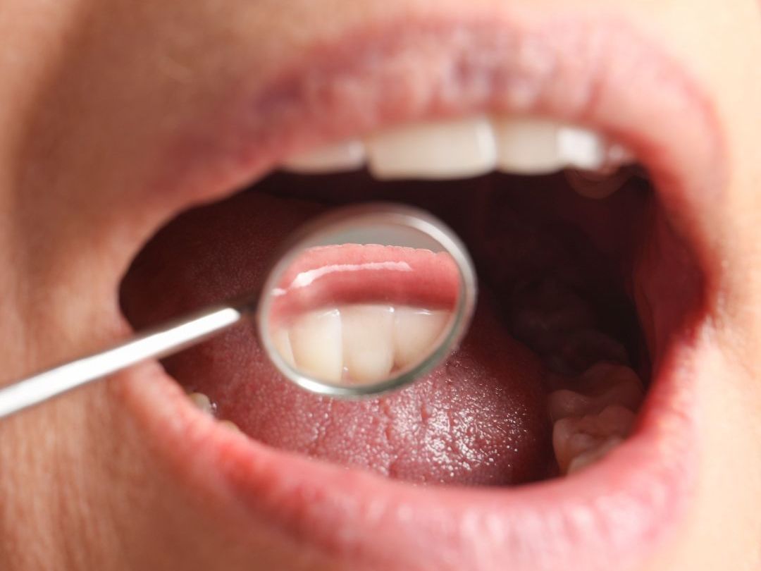 Oral cancer screening image