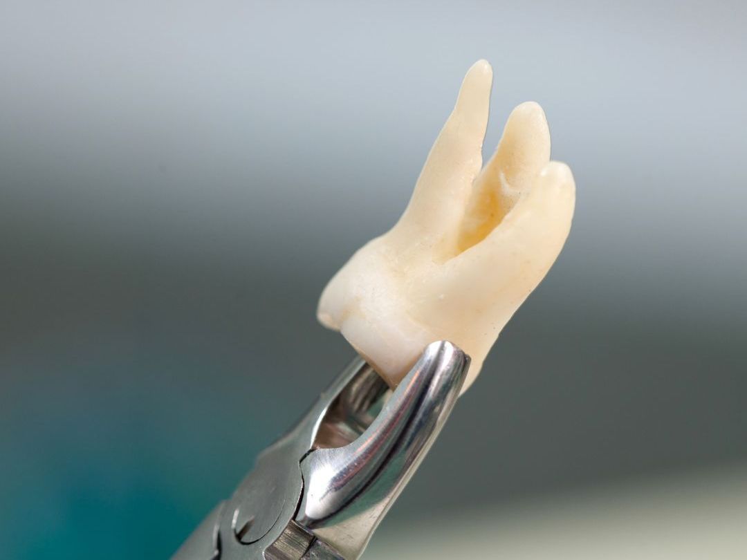 teeth extraction image