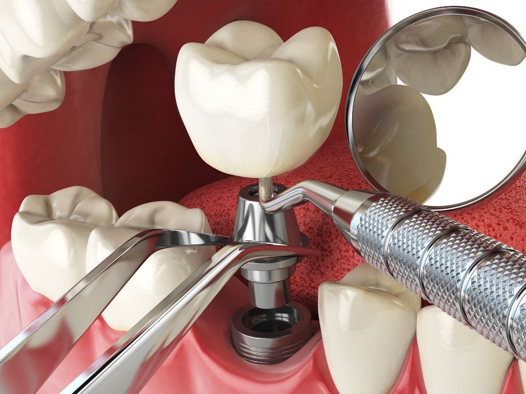 implant image