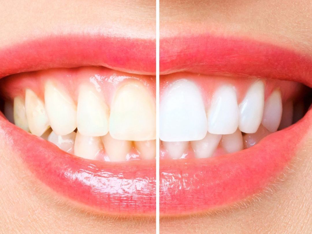 teeth whitening image