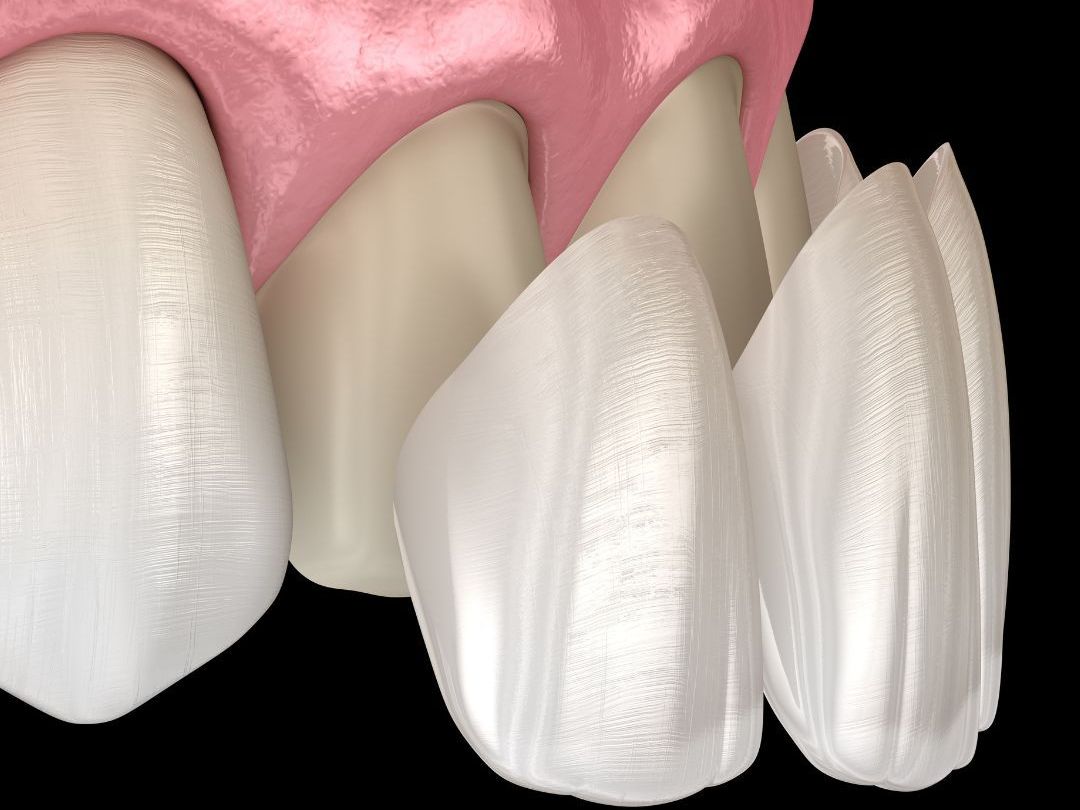 porcelain veneers image