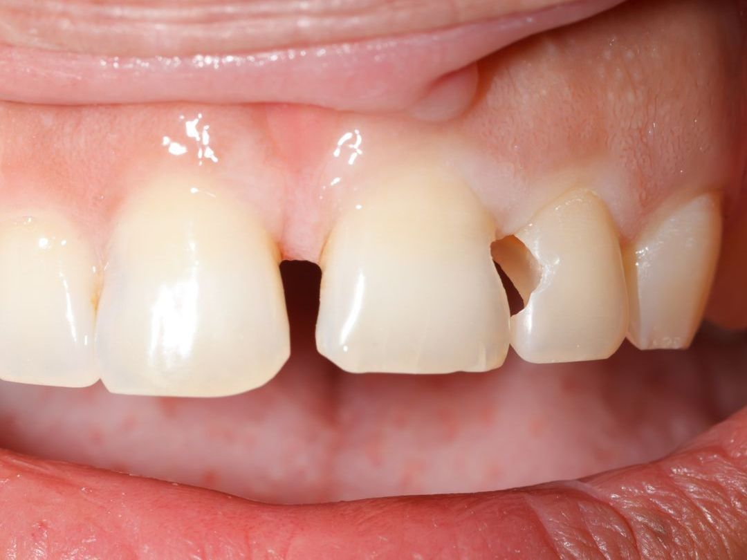 composite bonding image