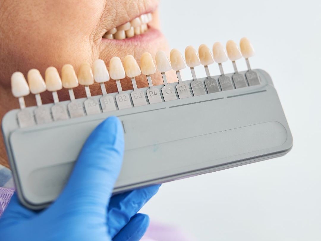 tooth color fillings image