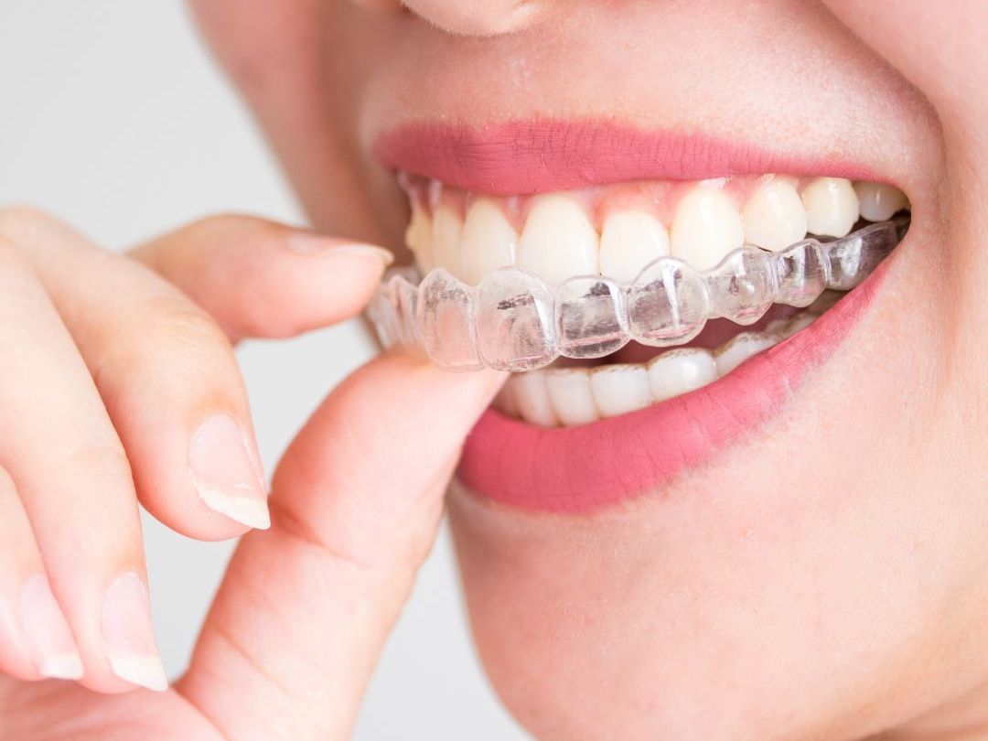 invisaligners image