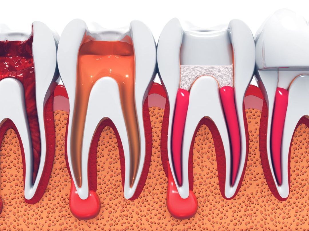 root canal image
