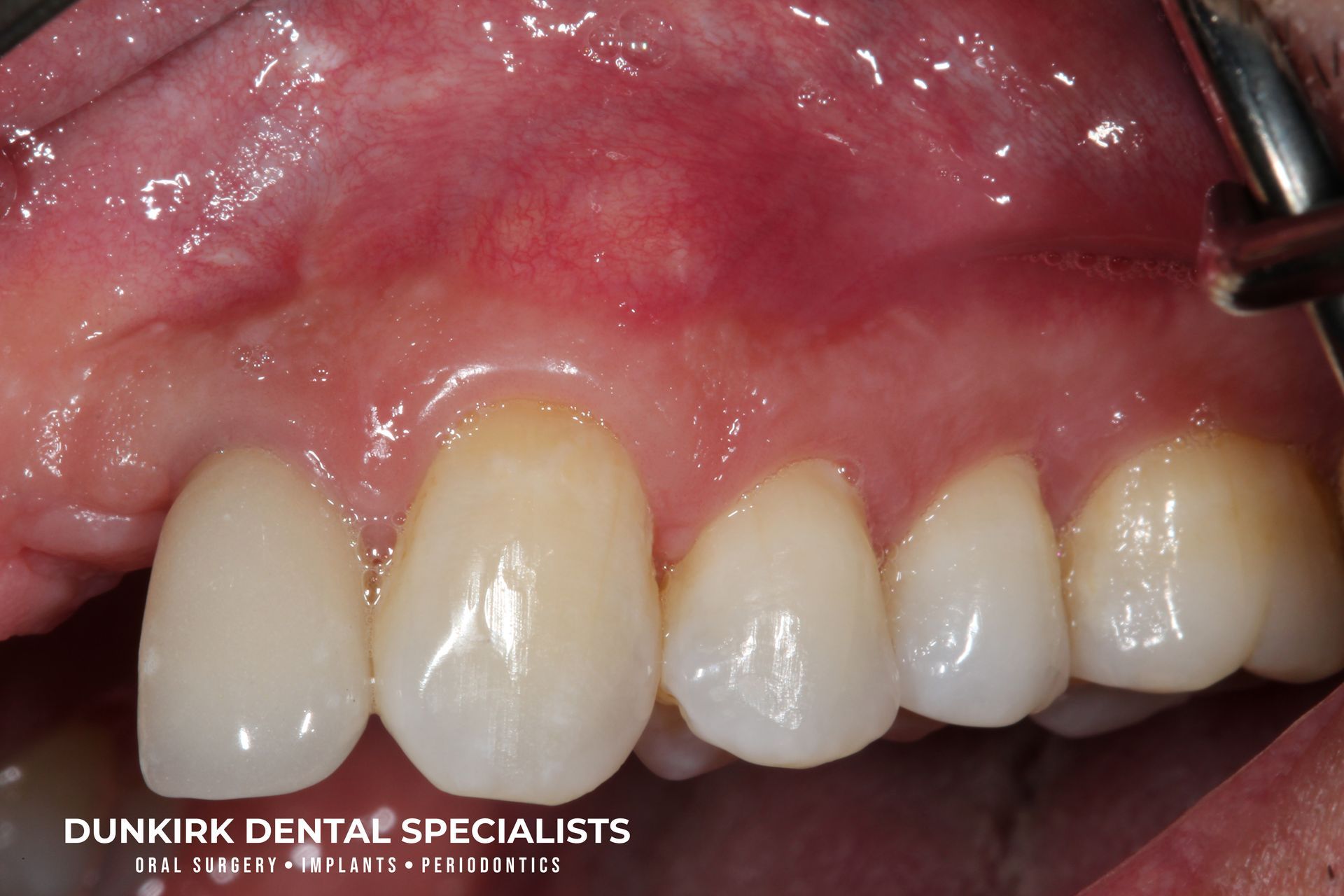 Gum grafting after