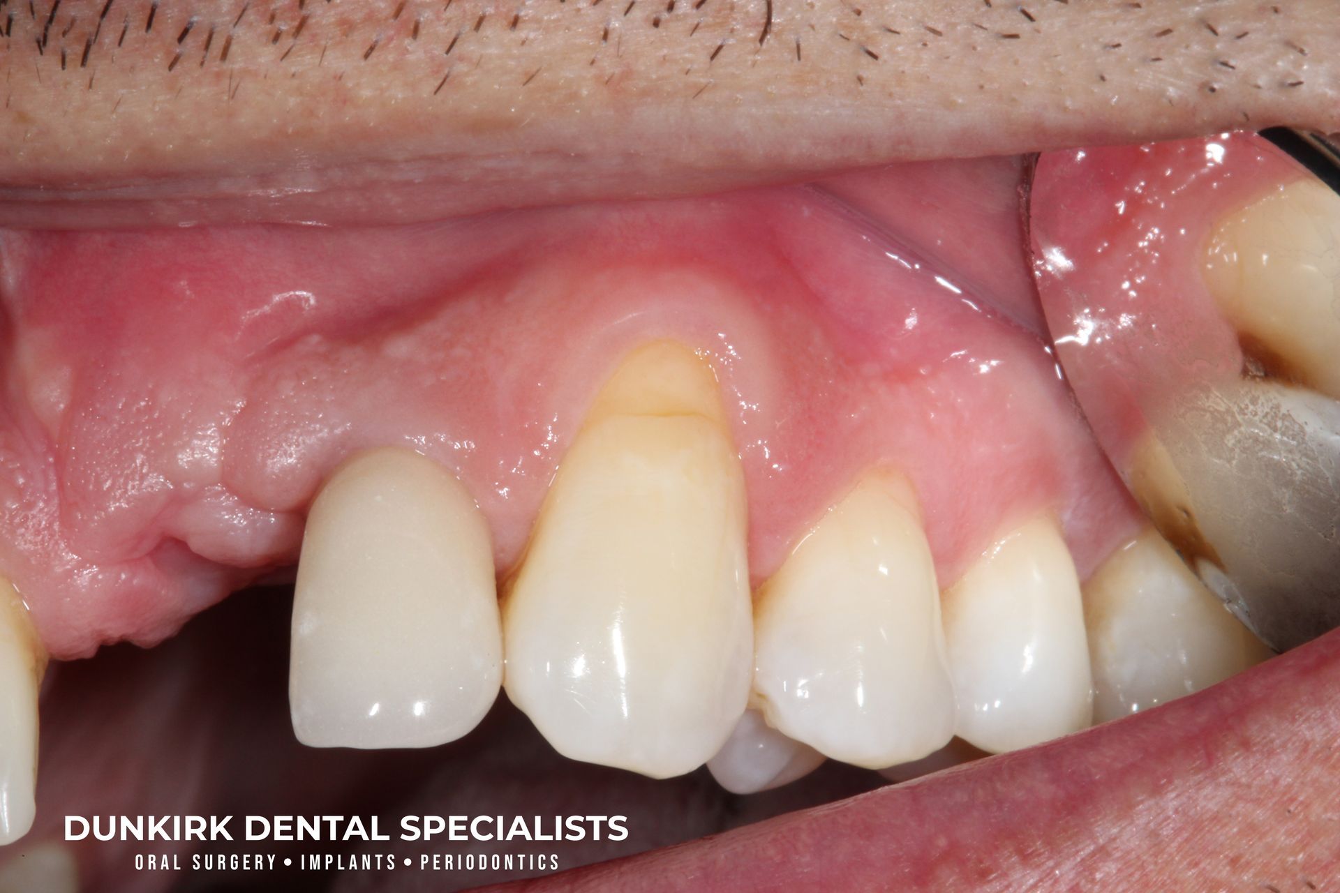 Gum grafting before