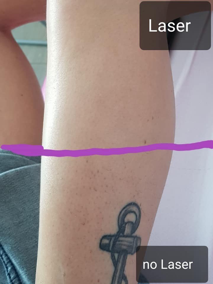 prima e dopo epilazione braccia