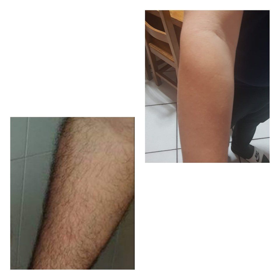 prima e dopo epilazione braccia uomo