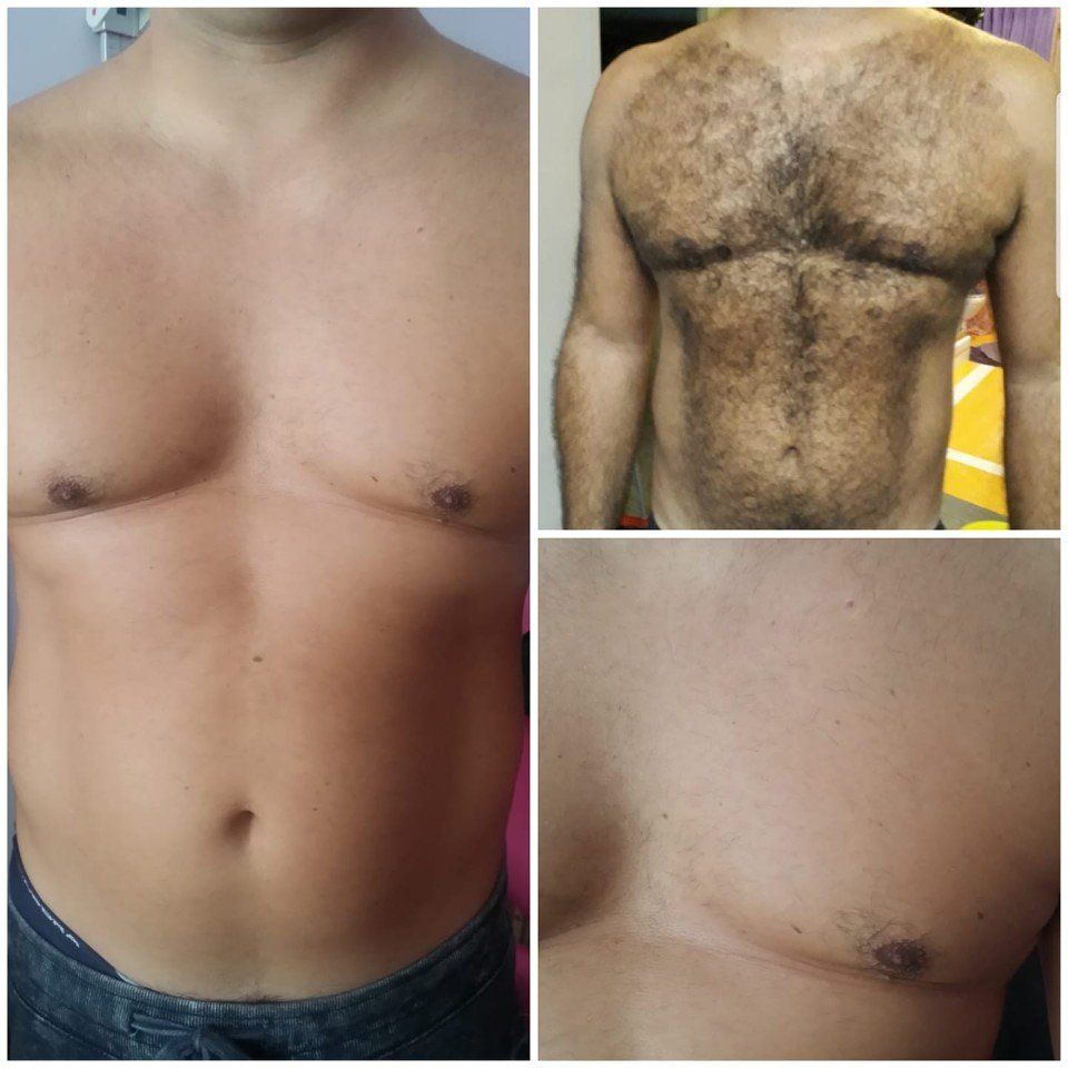 prima e dopo epilazione petto uomo