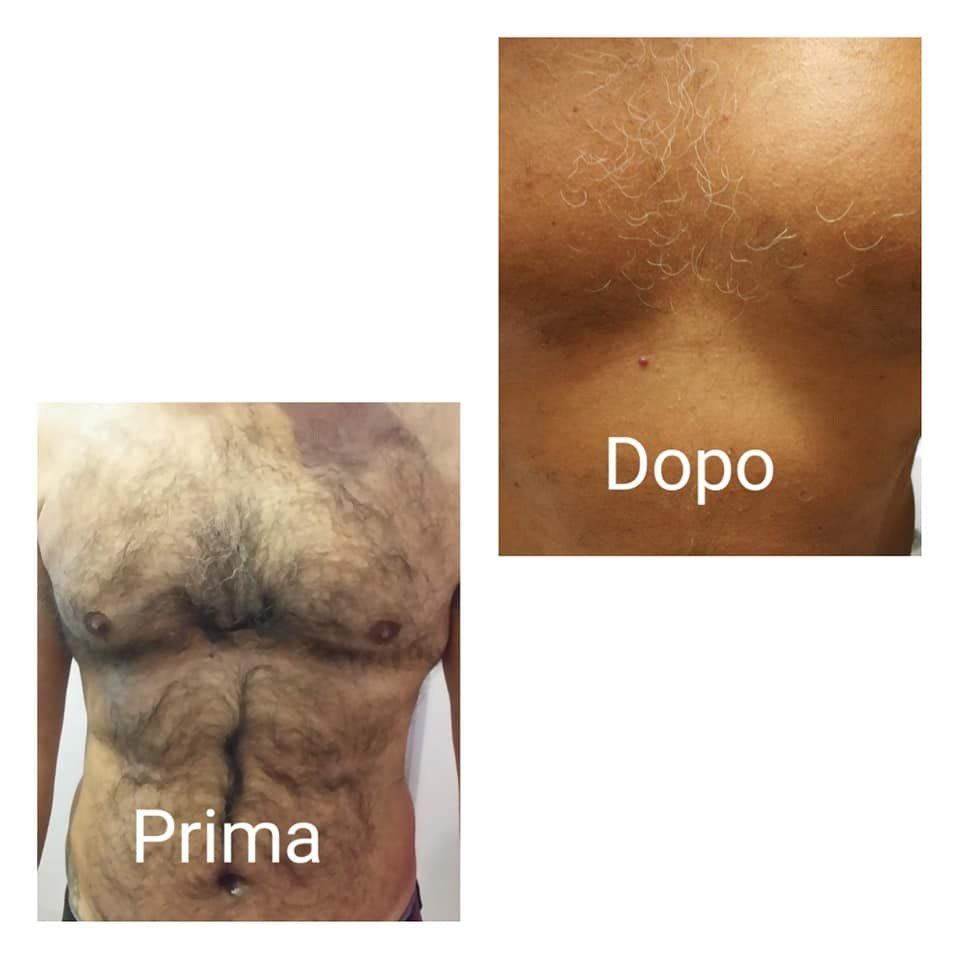 prima e dopo trattamento peli petto uomo