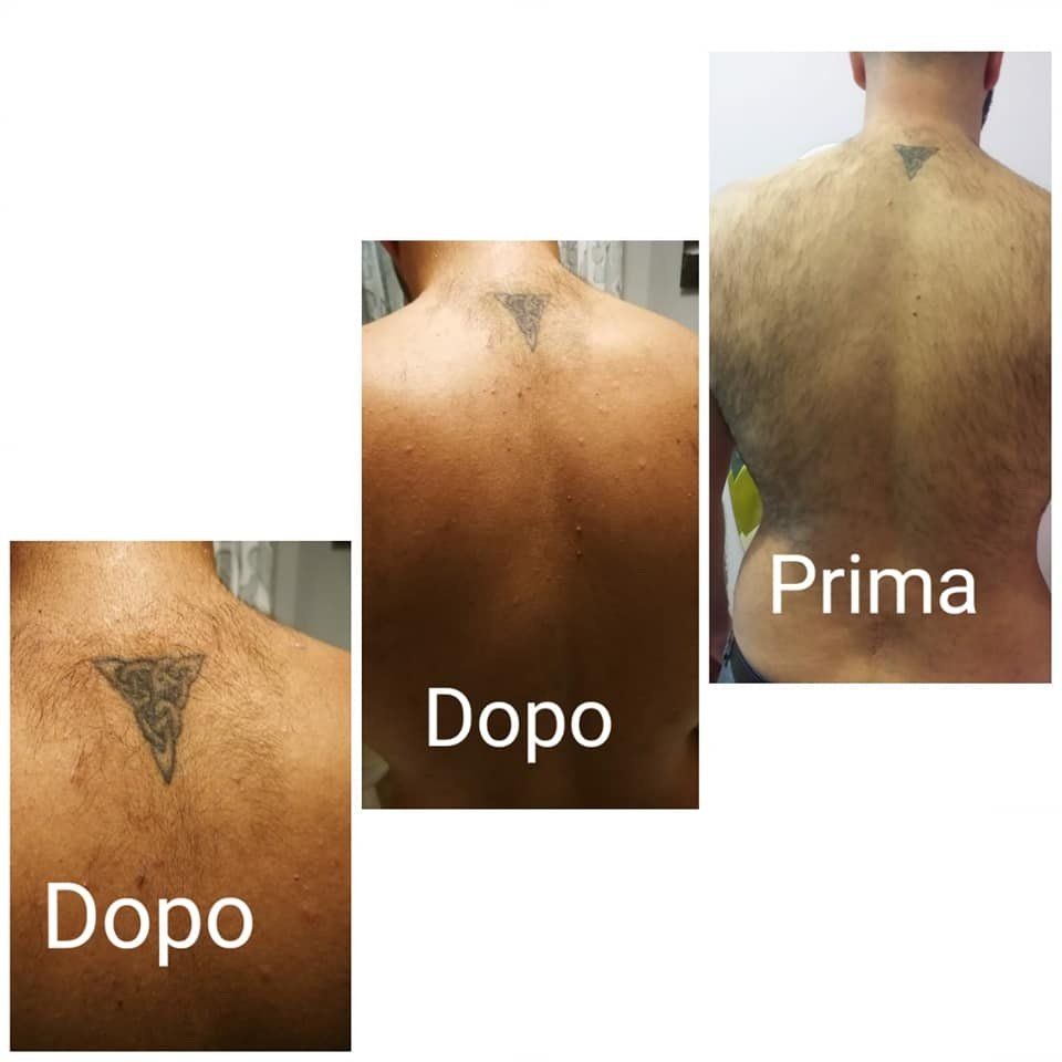 prima e dopo trattamento peli schiena uomo