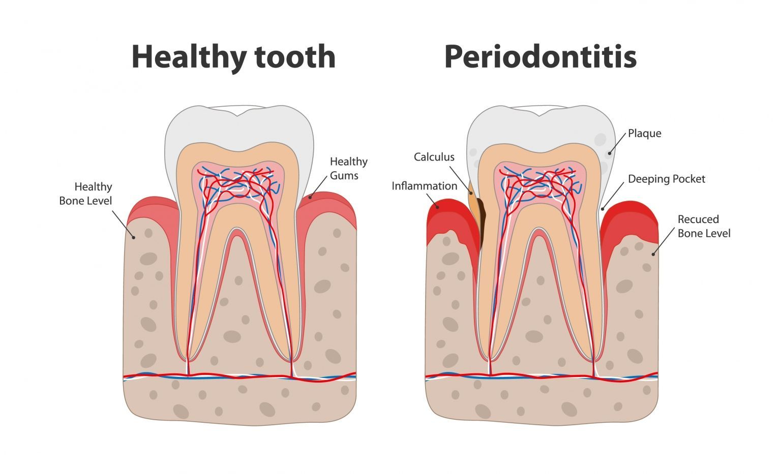 image of healthy tooth vs tooth with gum disease | Periodontists in Monroe and Highland Park NJ
