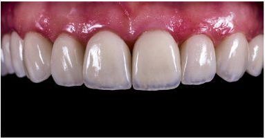 after dental veneers done by our family dentist in Monroe 08904 and Highland Park 08904